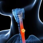 Рак пищевода