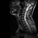 Рак спинного мозга