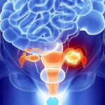 Рак яичников